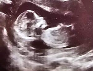 PTLS-symptoms-have-gone-away-after-tubal-reversal-now-pregnant