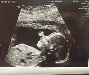 28-weeks-pregnant-after-reversing-tied-and-cut-tubes