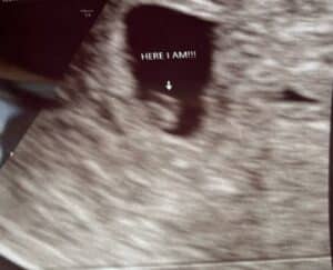 tubal-reversal-pregnancy-with-one-tube