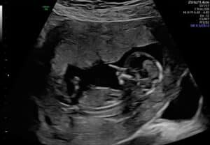 tubal-reversal-surgery-thornton-colorado-thirteen-weeks-pregnant