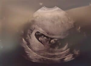 Adiana-reversal-florence-kentucky