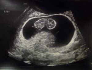 Essure-reversal-baby-pound-virginia