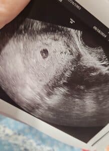 tubal-reversal-fort-lawn-south-carolina-tubal-clips