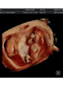 twin-girls-after-tubal-ligation-reversal