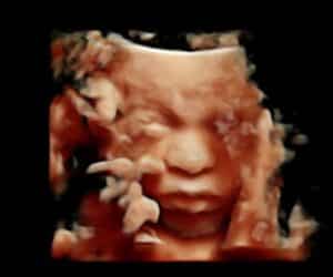 4d-ultrasound-tubal-reversal-baby-lenoir-tennessee