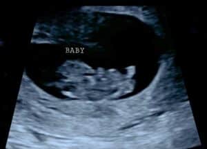 Randleman-nc-tubal-reversal-baby