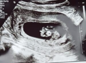 10-weeks-along-tubal-reversal-harris-pennsylvania