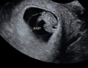 reversing-burned-tubal-ligation-blaine-minnesota