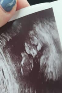 tubal-reversal-baby-thriving-at-13-weeks-after-tubal-clip-reversal