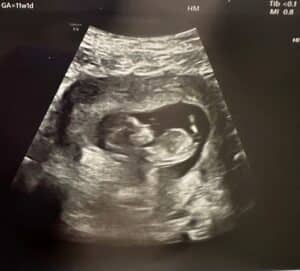 tubal-clip-reversal-baby