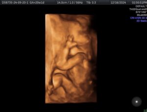 pals-gone-after-tubal-ligation-reversal-surgery