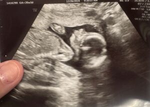 tubal-reversal-conway-sc-pregnancy-after-ectopic-pregnancy