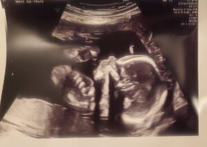 tubal-reversal-kenova-west-virginia-tubal-clips