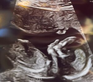 reversing-burned-tubes-hendersonville-north-carolina-healthy-baby-boy