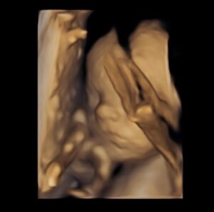 20-weeks-pregnant-after-reversing-tubal-rings-crane-mo