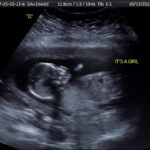 greenbrier-tn-tubal-reversal-baby