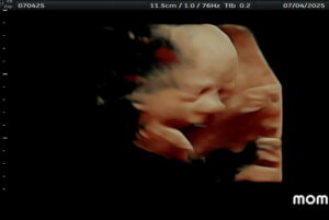 tubal-ring-reversal-corry-pennsylvania