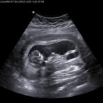 tubal-reversal-surgery-cabot-arkansas-mom-12-weeks-pregnant