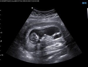 tubal-reversal-surgery-cabot-arkansas-mom-12-weeks-pregnant