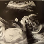 fair-oaks-ca-tubal-ligation-reversal-surgery