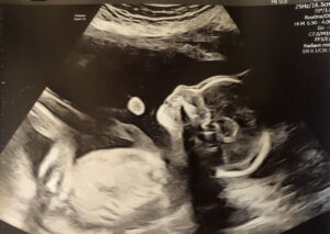 fair-oaks-ca-tubal-ligation-reversal-surgery