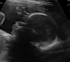 tubal-reversal-Georgia