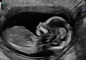 Broadway, Virginia, Tubal Reversal, Pregnancy