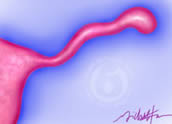 Fallopian tube damage due to infection of the tube may result in a swollen, club-shaped tube called a hydrosalpinx