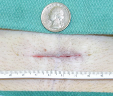 tubal-reversal-incision-of-patient-Georgia-Peach.
