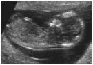 After-tubal-reversal-nuchal-translucency-evaluation-of-early-pregnancy-can-be-chosen