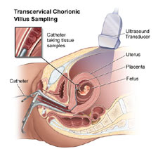 After-tubal-reversal-cvs-is-an-early-diagnostic-test-which-can-be-chosen