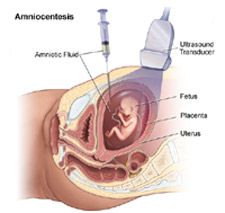 Amniocentesis-can-be-chosen-to-evaluate-pregnancies-after-tubal-ligation-reversal
