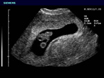 Ultrasound-of-early-pregnancy-after-tubal-ligation-reversal
