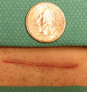 An-example-of-an-out-patient-tubes-reversed-incision