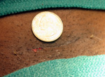 typical-reversal-incision