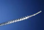 essure-coils-can-be-removed-and-pregnancy-may-occur
