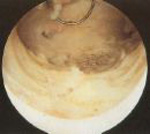 Ablation of endometrium makes implantation difficult