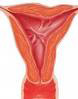 Uterine scarring can be a complication of uterine ablation