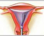 Endometrial ablation removes the endometrial lining