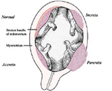 Placental abnormality is a risk after endometrial ablation