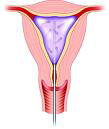 Balloon ablation is one type of endometrial ablation procedure