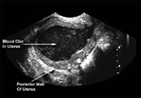 Hematometra can be a complication of endometrial ablation