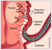 Uterine artery embolization blocks the uterine arteries