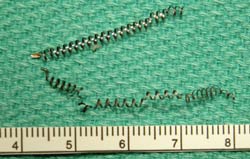 essure coils after removal