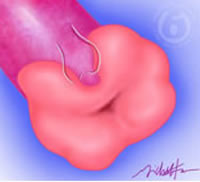 ampullary salpingostomy reverses tubal blockage from scar tissue