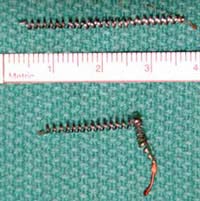 essure--coils-after-removal