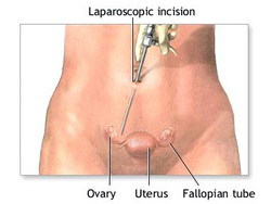 screening-laparoscopy-is-a-good-tubal-reversal-consideration